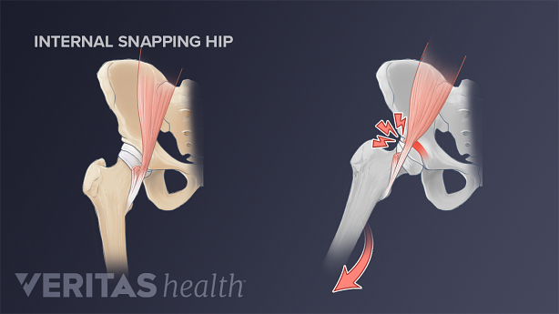 Side-by-side illustration of an internal snapping hip