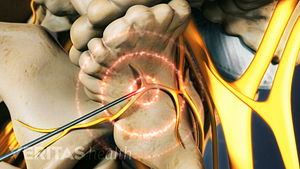 Lumbar radiofrequency ablation into facet joint.
