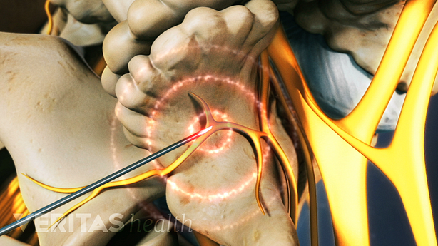 Close up depiction of a radiofrequency ablation being performed on a vertebral nerve.