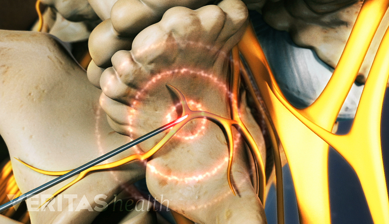 Close up depiction of a radiofrequency ablation being performed on a vertebral nerve.