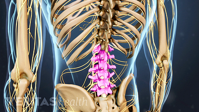 Spinal Stenosis - A Short Blog Post From Emed