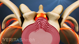 Superior view of a herniated disc in the cervical spine.