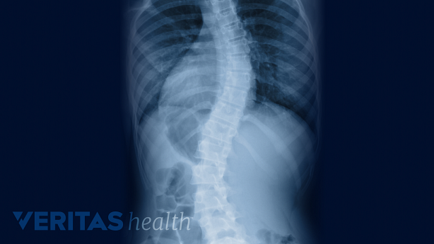 X-ray image on a human spine from behind that is in a s-shape visualizing scoliosis.