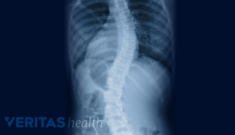 X-ray image of spinal vertebra showing scoliosis.