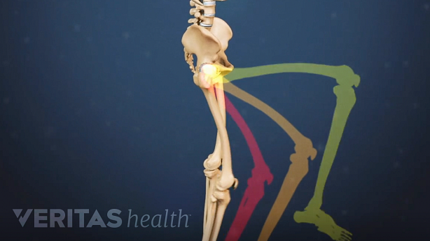 Illustration of leg weakness.