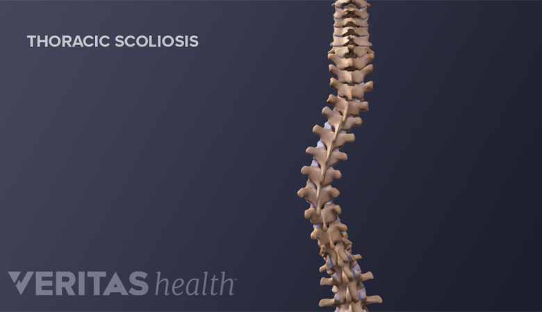 Medical illustration showing adult spine with scoliosis.