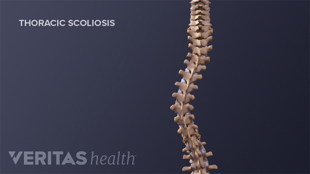 Illustration of adult spine with thoracic scoliosis