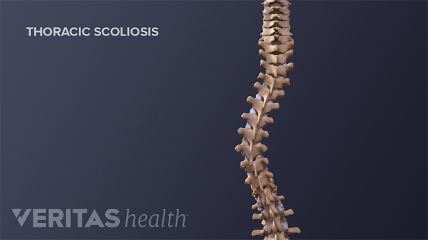 Medical illustration showing adult spine with scoliosis.