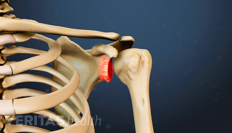 Illustrated skeletal view of the shoulder. Osteophytes in the shoulder joint are highlighted in red indicating pain