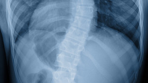 X-ray scan showing spine curvature caused by scoliosis