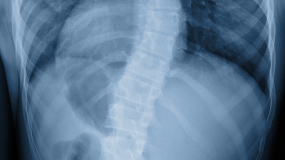 Anterior view of scoliosis on x-ray