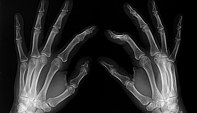 X-ray hand with a broken finger.