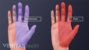 Palmar view of two hands showing numbness and pain through the ring finger and thumb.