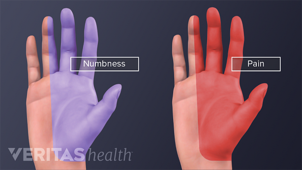 Palmar view of two hands with numbness and pain caused by carpal tunnel syndrome.