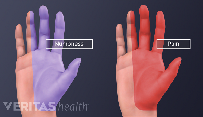 Illustration showing hand indicating numbness and pain.