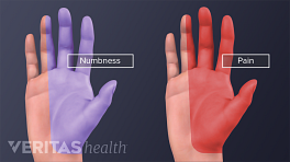 双手的手掌视图，通过无名指和拇指显示麻木和疼痛。