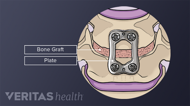 Two vertebrae with bone graft, plates, and screws.
