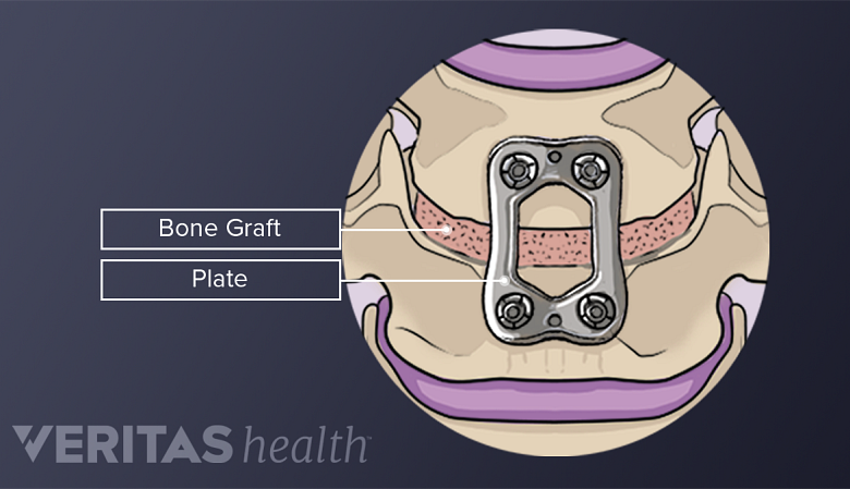 Labeled illustration of a cervical bone graft fusion.