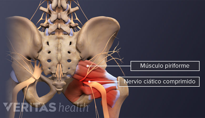 El nervio ciático comprimido por el músculo piriforme.