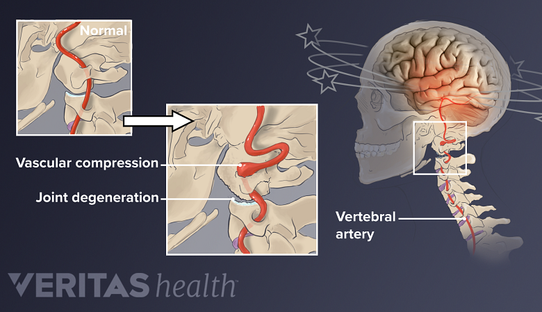 A medical illustration showing vascular compression and joint degeneration and dizziness.