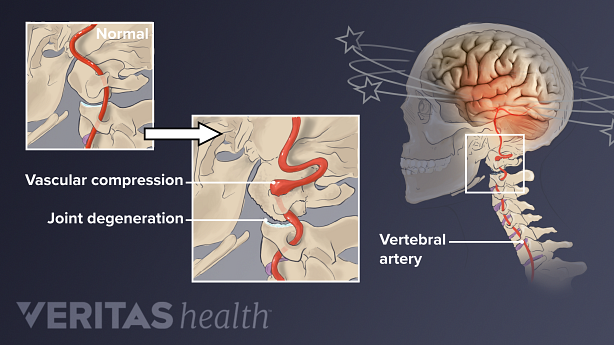 Illustration of how bone and disc degeneration in the cervical spine can cause dizziness