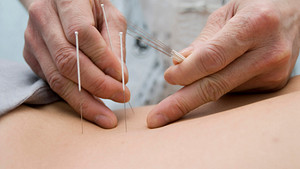 An acupuncturist is placing needles in a persons back