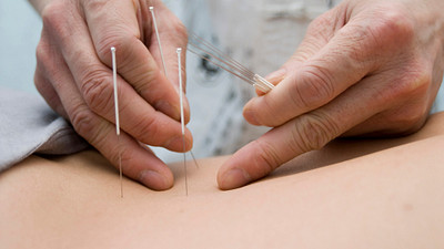 Acupuncturist inserting needles into a person&#039;s back.