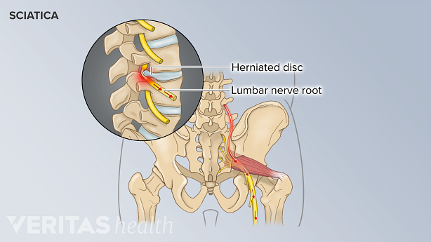 A herniated disc in the lower back pinching the sciaitc nerve root, sending pain signals down the sciatic nerve.