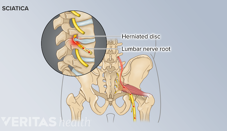 Posterior view of sciatica in the pelvis labeling a lumbar nerve root with a herniated disc