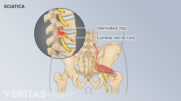A herniated disc in the lower back pressing on a spinal nerve, causing sciatica pain.
