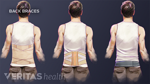 Illustration of corset, lumbar belt, and sacroiliac belt flexible braces for lower back pain