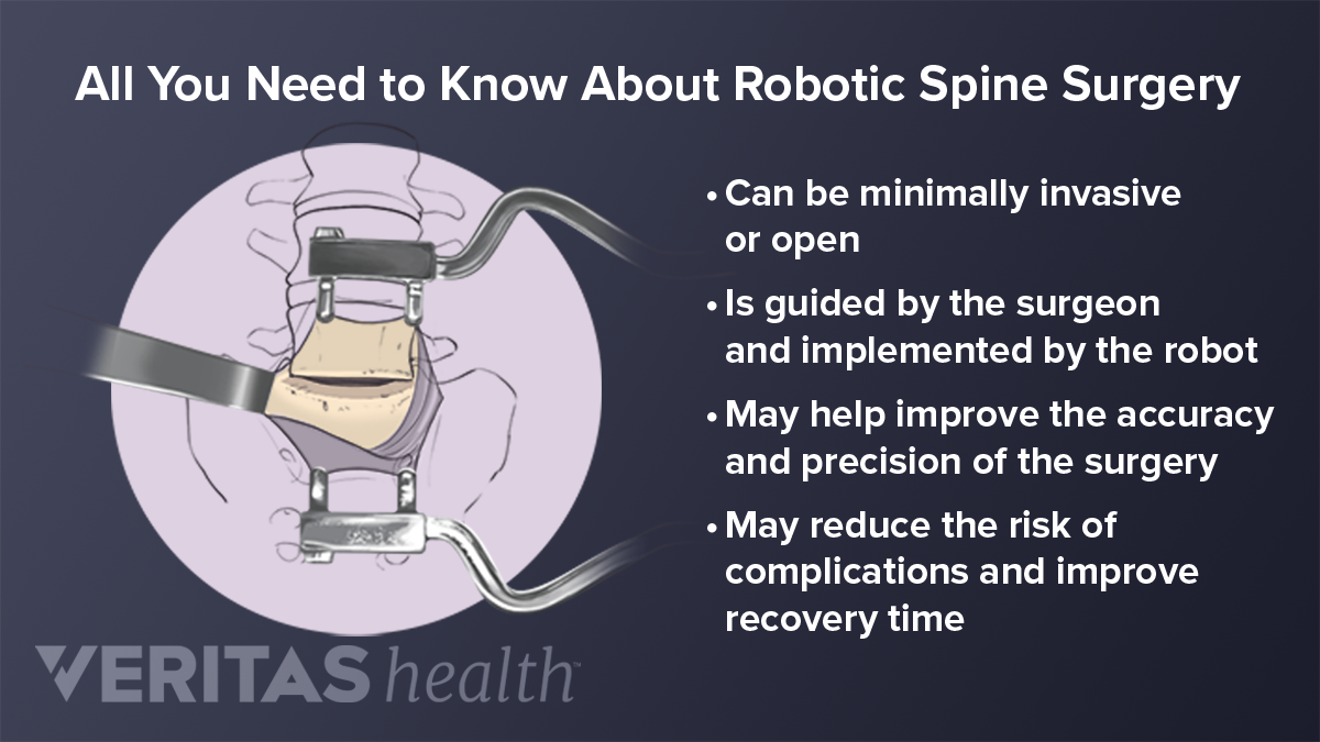 What You Need To Know About Robotic Spine Surgery | Spine-health