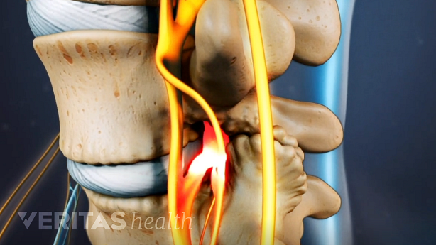 Representación 3D de la columna lumbar con raíces nerviosas inflamadas resaltadas en rojo.