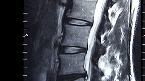 MRI scan of the lumbar spine.
