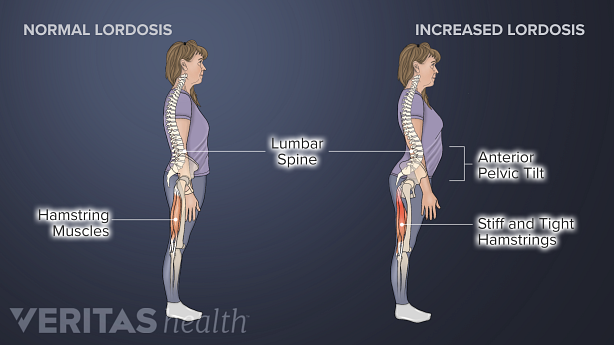 Illustration showing normal lordosis and increased  lordosis.