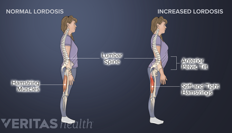 Illustration of normal and increased lordotic curves in the lower back highlighting anterior pelvic tilt and tight hamstrings.