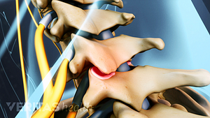 Sideview of vertebrae with one facet joint highlighted in red to indicate pain