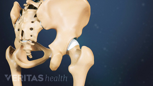 Close up of a medical illustration of a hip joint