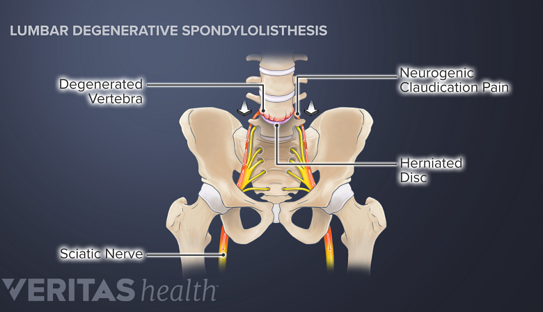 Illustration of a pelvis showing  sciatic nerve, neurogenic claudication pain, herniated disc.