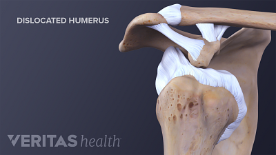 Anterior view of the shoulder joint showing a dislocated humerus