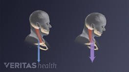 Comparison of good posture and poor posture in the cervical spine.