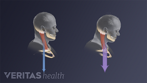 Comparison of good posture and poor posture in the cervical spine.