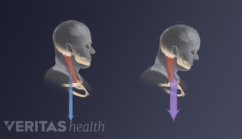 How Poor Posture Causes Neck Pain