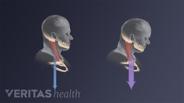 Proper head posture compared with forward head posture