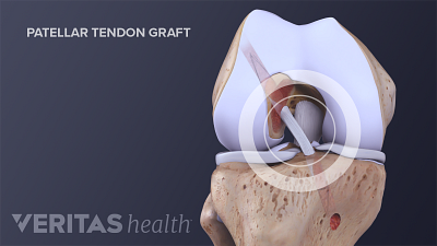 膝关节的前视图显示股骨隧道,胫骨隧道和髌韧带移植物。