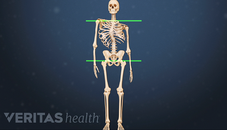 Illustration showing a skeleton with scoliosis.