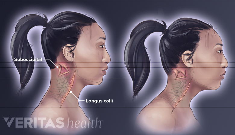 Muscle changes in the neck’s longus colli and suboccipital muscles from poor posture.