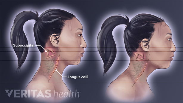 Medical illustration the effect of forward head posture on the longus colli and suboccipital neck muscles