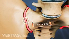 Close up illustration of inflamed sacroiliac joint, which is called sacroilitis.