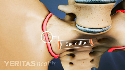 Close up illustration of inflamed sacroiliac joint, which is called sacroilitis.